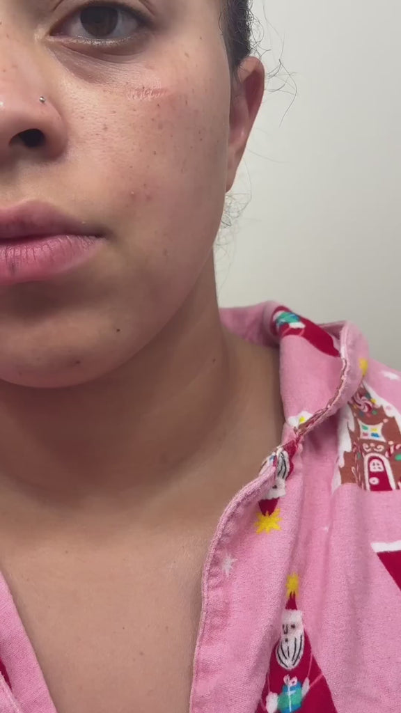 Jia Wipeout Acne Pimple Patches Review